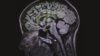 MRI scan of a brain suffering from seizure