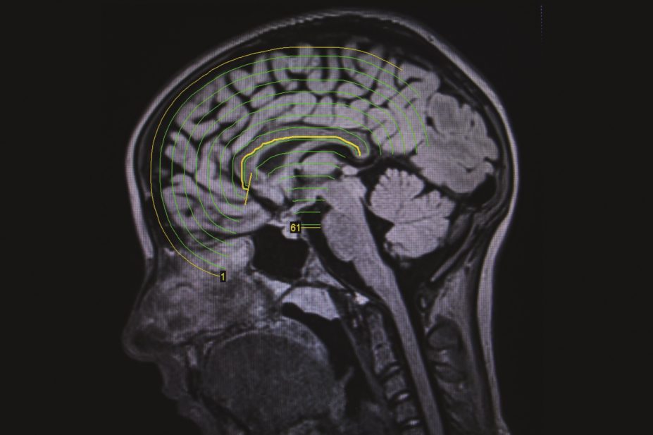 MRI scan of a brain suffering from seizure