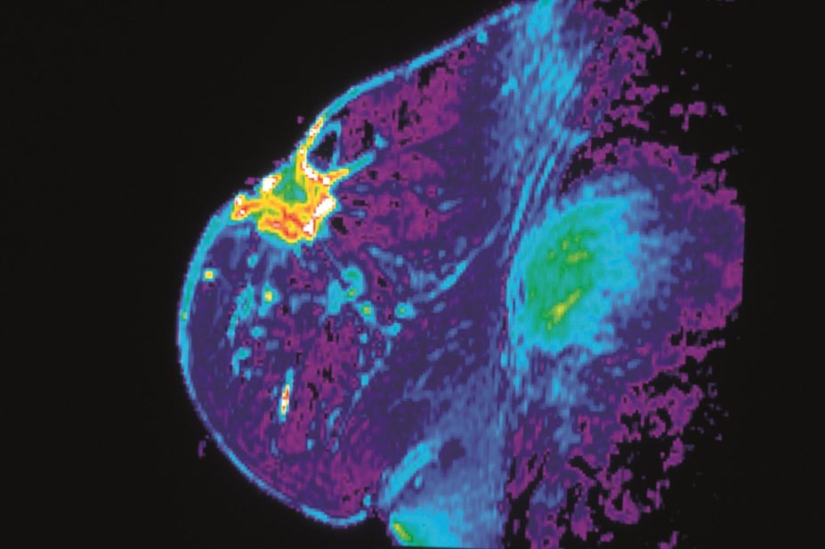 Management of early breast cancer involves aromatase inhibitors (AIs) and tamoxifen to prevent recurrence. Taking an AI for 5 years reduced 10-year breast cancer mortality by around 15%. In the image, MRI scan of a patient with breast cancer