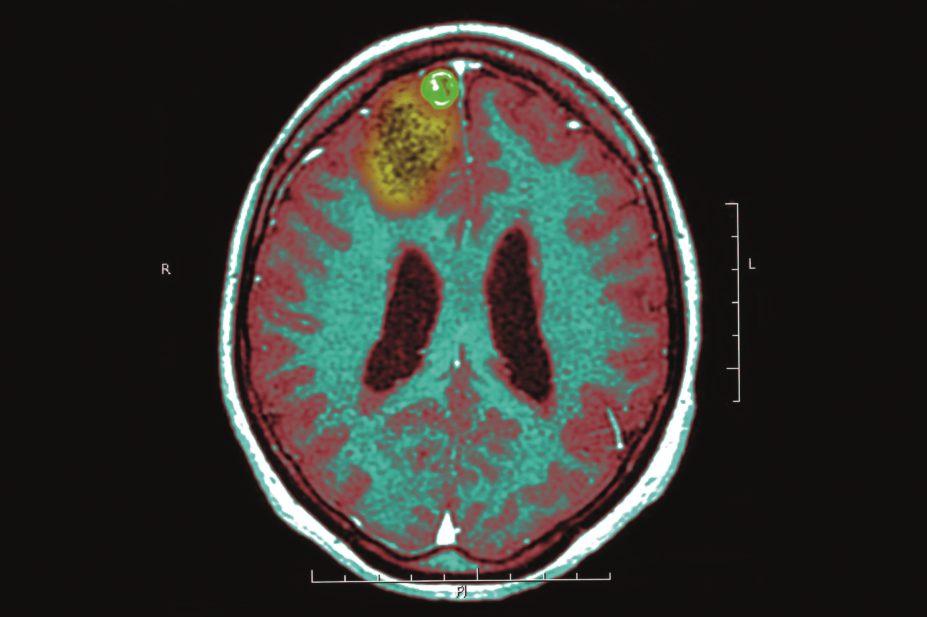 Shutting down a metabolic pathway that fuels misfiring neurons can suppress seizures in mice. In the image, an MRI scan of a person with epilepsy