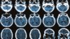 Glucagon-like peptide-1 (GLP-1) receptor agonist drug used to treat type 2 diabetes could help against alzheimer's, study finds. In image, MRI scan of a human brain