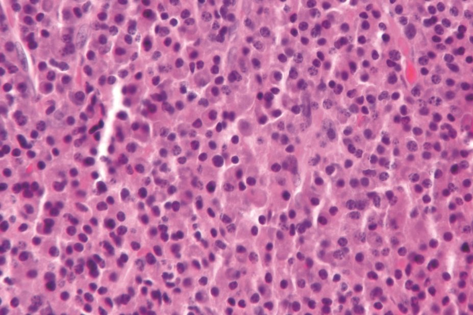 The US Food and Drug Administration (FDA) has fast-tracked the approval of the first histone deacetylase (HDAC) inhibitor to treat patients with multiple myeloma (pictured)