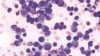Histopathological image of multiple myoloma