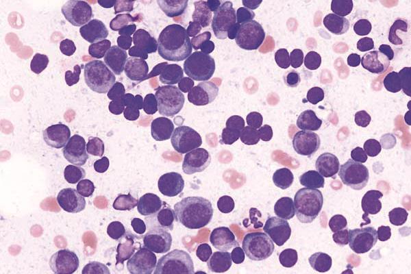 The European Medicines Agency is recommending elotuzumab (Empliciti) for use as a combination therapy for multiple myeloma. Pictured, a histopathological image of multiple myeloma.