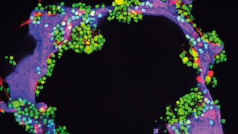 Micrograph of multiple myeloma tumour cells (green) and bone cells (red) growing on a scaffold made of silk protein (purple), designed to resemble bone material