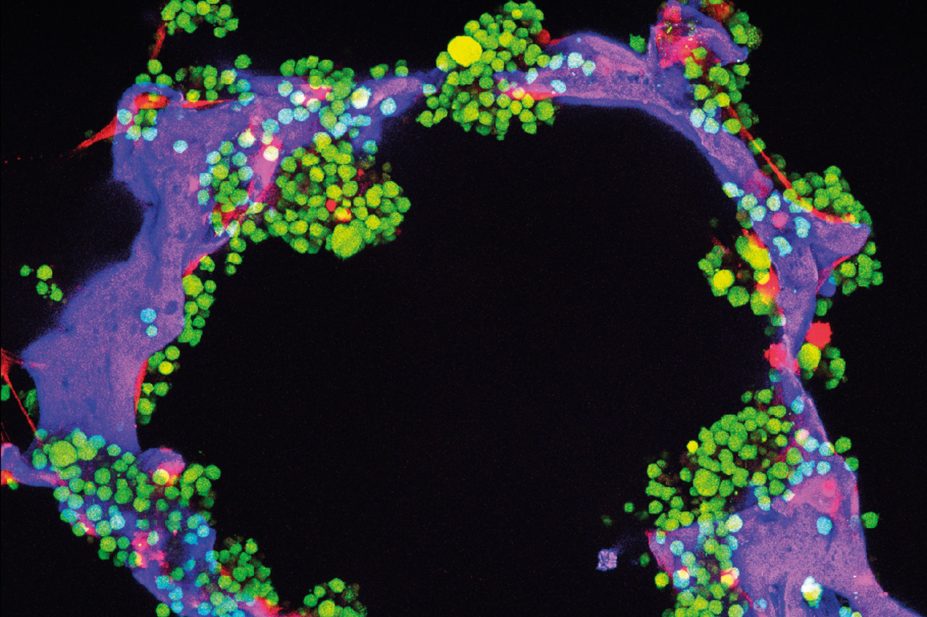 Micrograph of multiple myeloma tumour cells (green) and bone cells (red) growing on a scaffold made of silk protein (purple), designed to resemble bone material