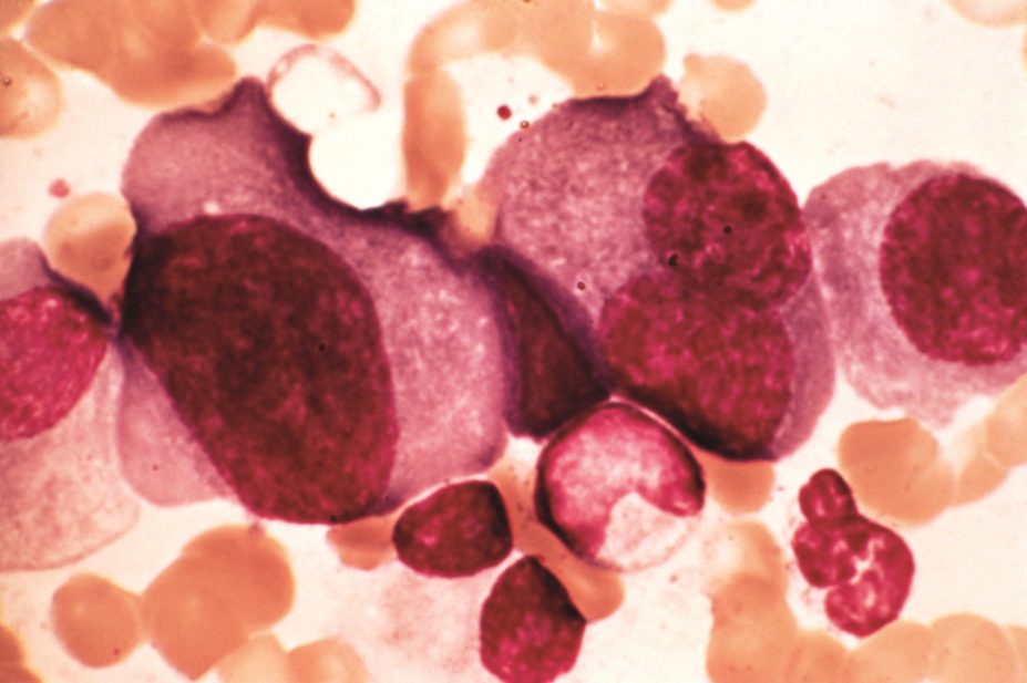 Elotuzumab (Empliciti, Bristol-Myers Squibb), a new immune-stimulating treatment for multiple myeloma (micrograph pictured) has been approved by the US Food and Drug Administration (FDA)
