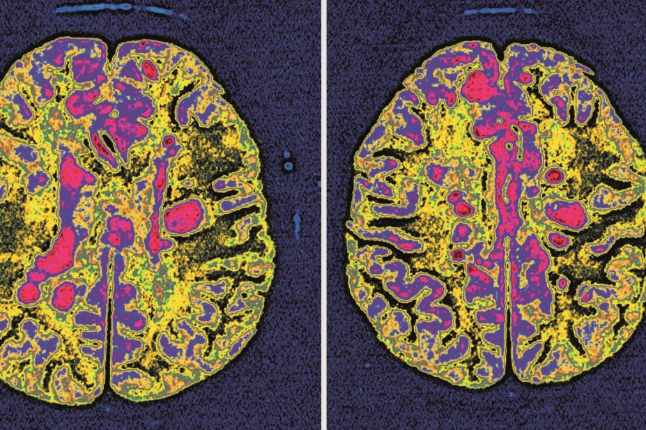 Interferon beta and glatiramer acetate each reduce disability progression by 24-40% in patients with relapsing-remitting multiple sclerosis (MS) and were found to be cost-effective. In the image, a brain scan of a patient with MS