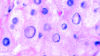 Micrograph of non-alcoholic fatty liver (NAFL)