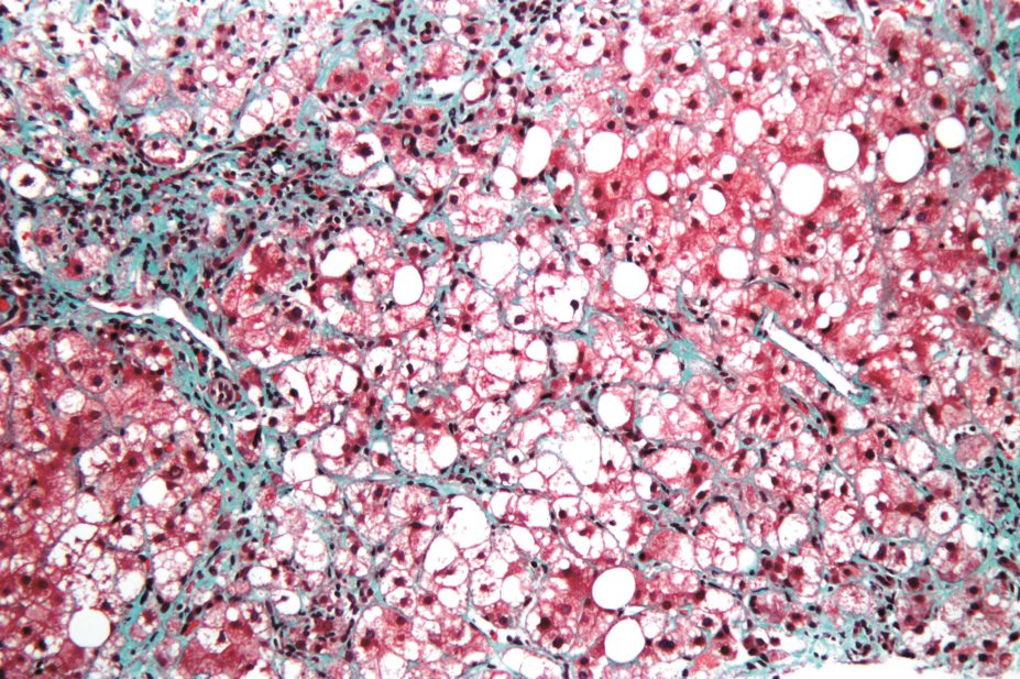 Researchers have found that the glucagon-like peptide-1 analogue liraglutide – a treatment for type 2 diabetes – is also effective in non-alcoholic steatohepatitis (NASH), micrograph pictured