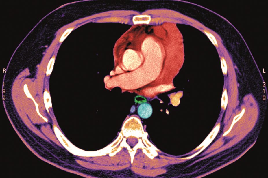 CT scan of the heart
