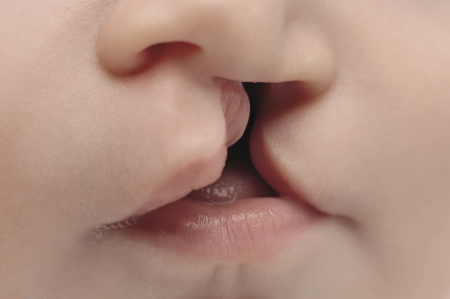 Oral cleft lip close-up