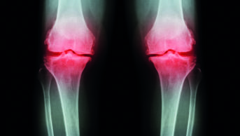 Osteoarthritis knee X ray