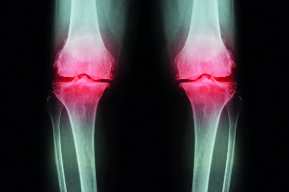 Osteoarthritis knee X ray