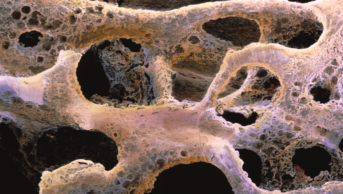 Scanning electron micrograph of osteoporotic bone