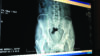 osteoporotic hip