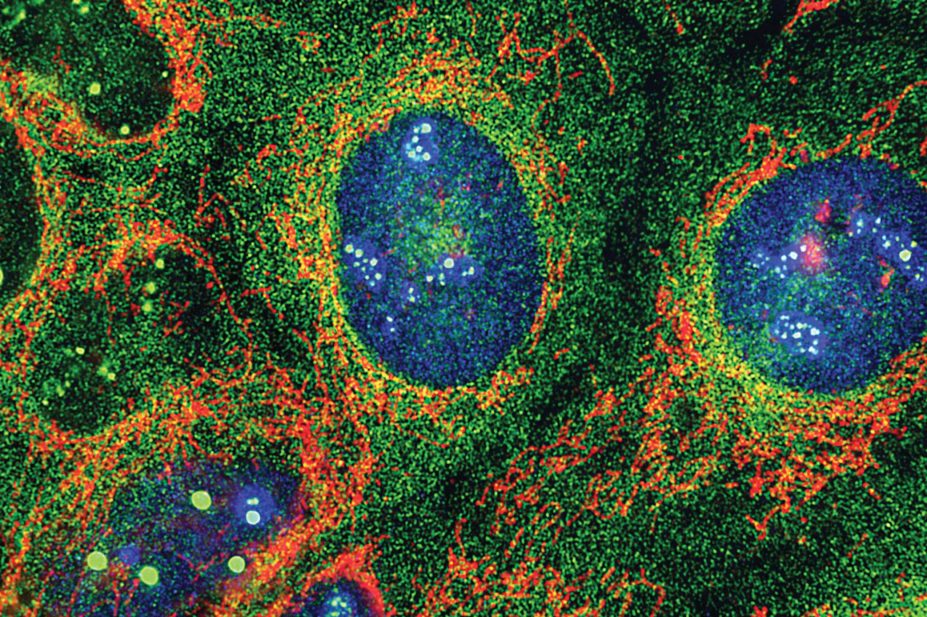 Light micrograph of osteosarcoma cells