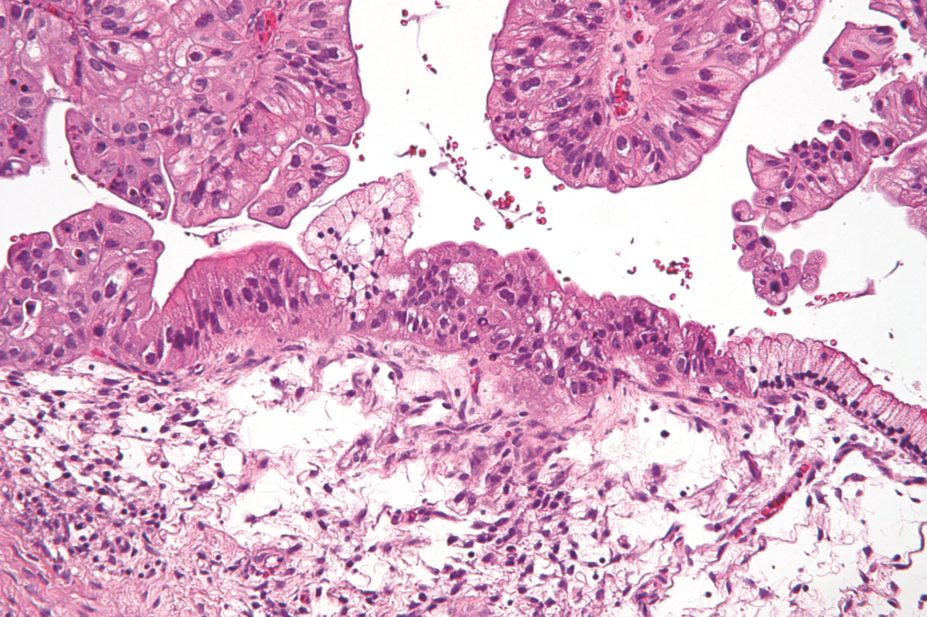 Taking a certain type of beta blocker could prolong the lives of women with ovarian cancer by up to five years. In the image, micrograph of ovarian cancer