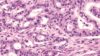 Pancreatic ductal adenocarcinoma (micrograph pictured) is a cancer with rising incidence and very poor outcomes.Metformin, used for diabetes, was found to shut down metabolism in pancreatic cancer stem cells, which can spread cancer around the body