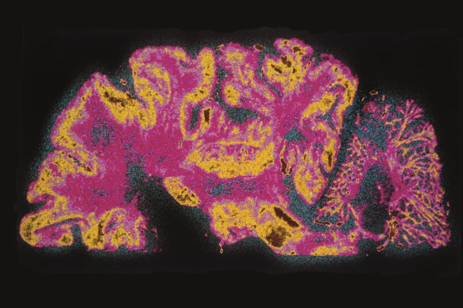 Use of anticholinergic drugs by patients with newly diagnosed Parkinson’s disease is not associated with cognitive decline, according to new research. In the image, MRI brain scan of a patient with Parkinson's disease
