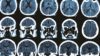 Parkinson’s disease in MRI brain scan