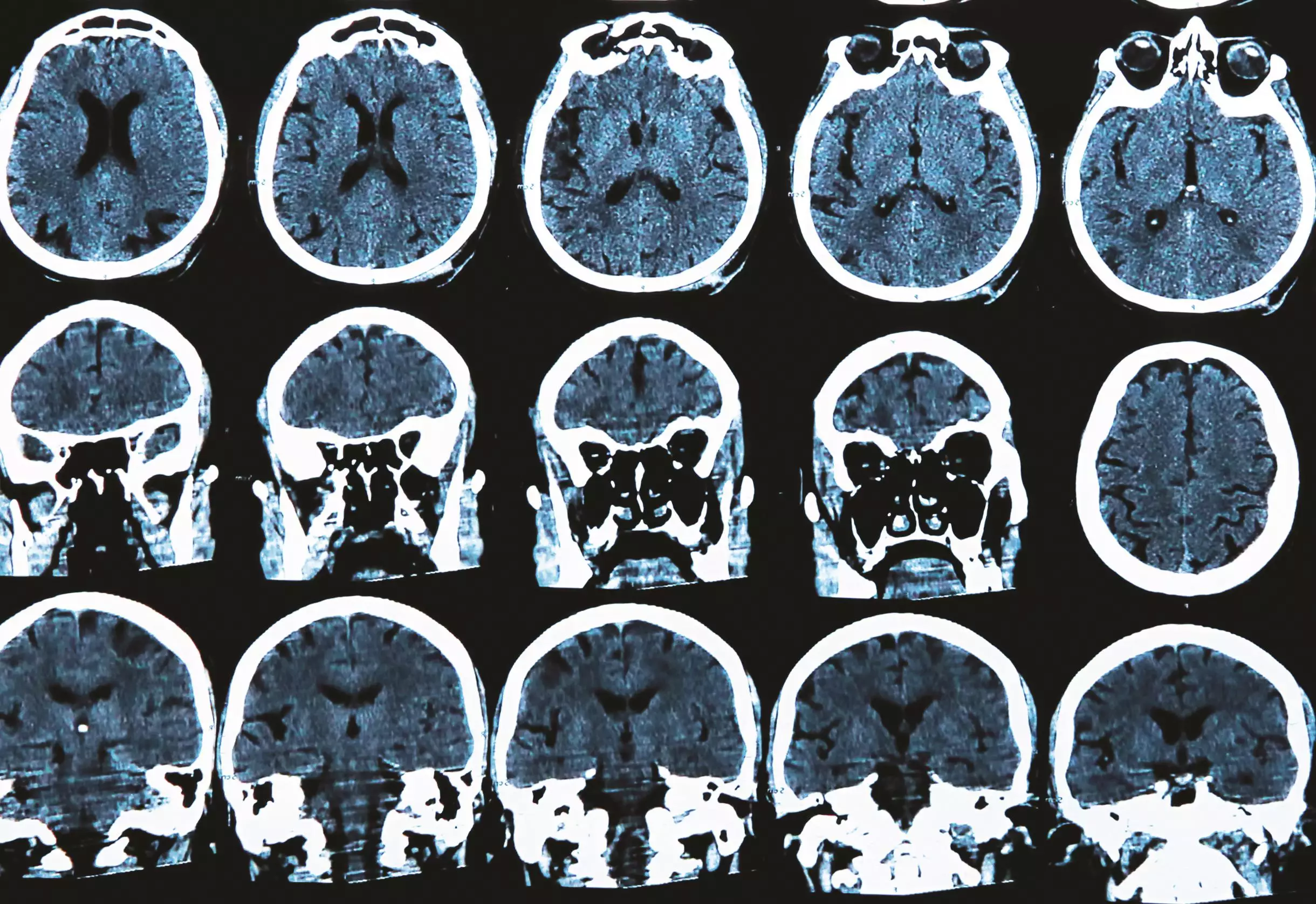 Experimental diabetes drug shows promise in Parkinson’s disease - The ...