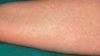 All forms of natural and semisynthetic penicillins, or drugs with a similar structure such as cephalosporins or carbapenems, can cause allergy. In the image, penicillin allergy rash in forearm