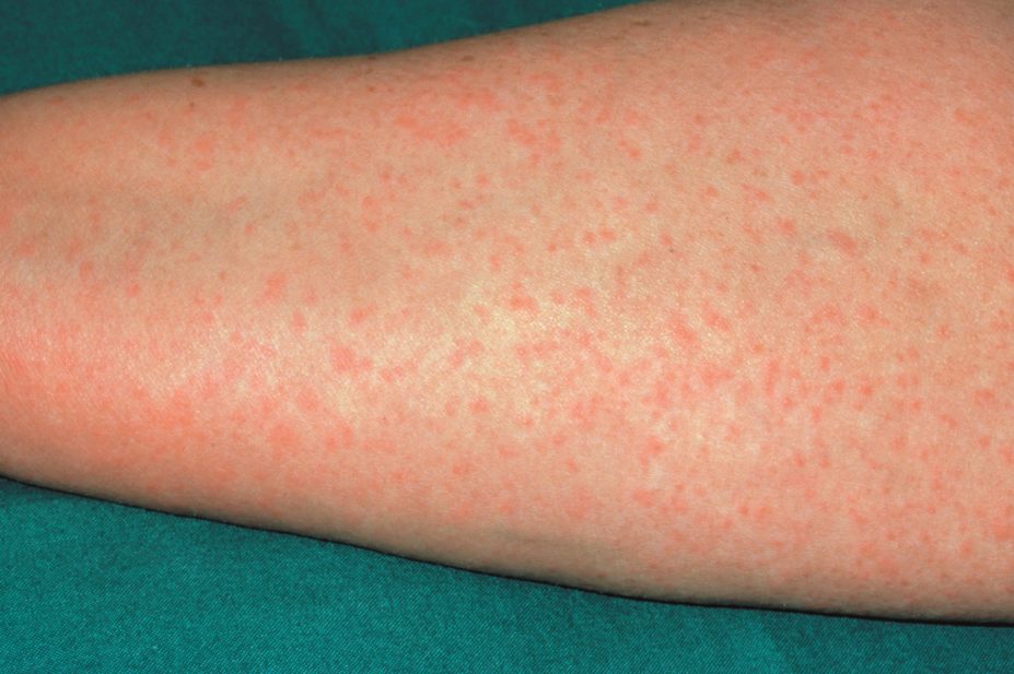 All forms of natural and semisynthetic penicillins, or drugs with a similar structure such as cephalosporins or carbapenems, can cause allergy. In the image, penicillin allergy rash in forearm