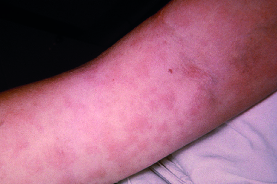 Penicillin rash in the arm, allergic reaction of patient to penicillin