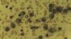 Plasma cells in multiple myeloma patient