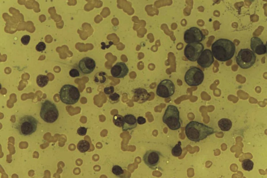 Plasma cells in multiple myeloma patient
