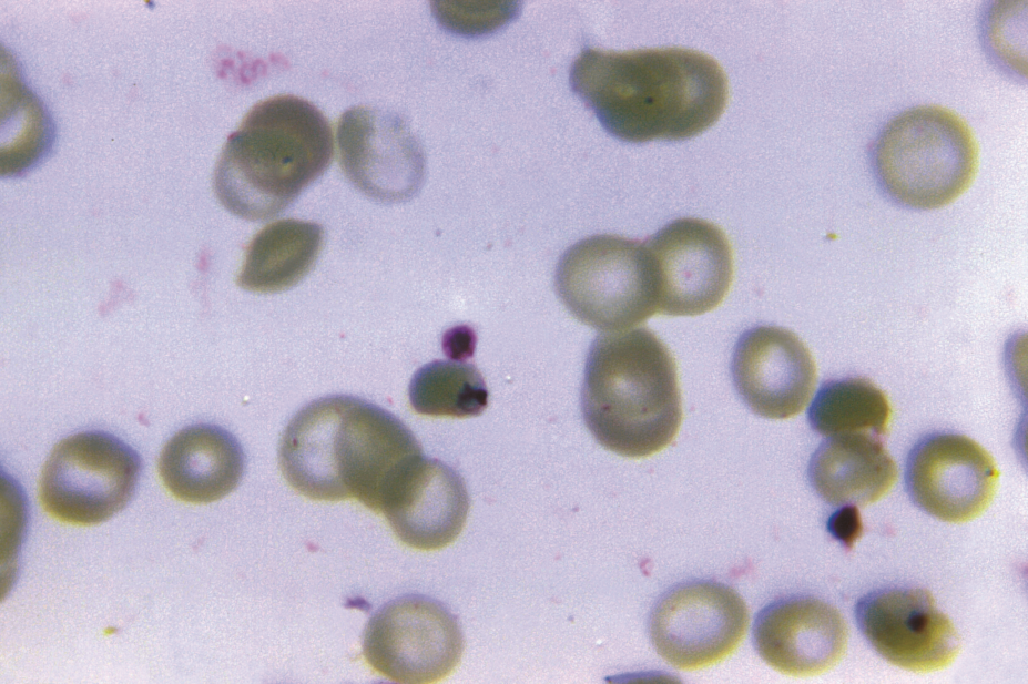 Micrograph of Plasmodium falciparum malarial parasite