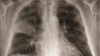 Xray of lungs showing pneumonia