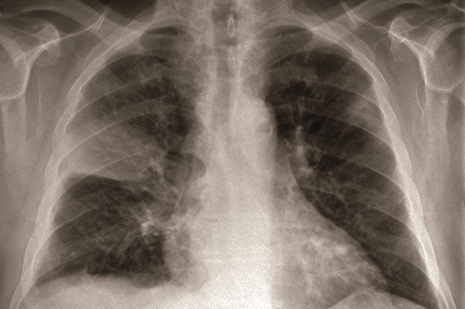 Xray of lungs showing pneumonia