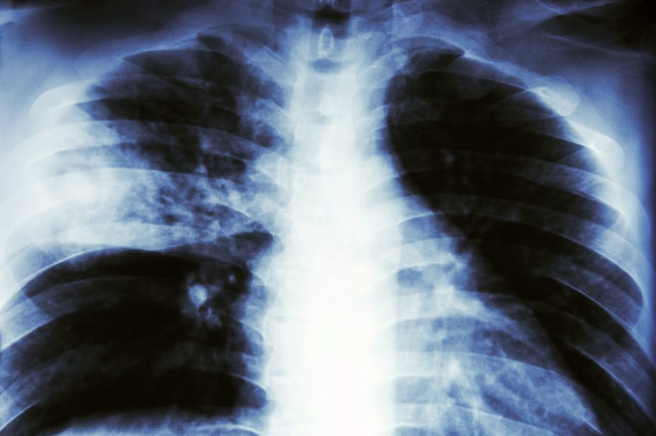 X-ray of lungs with pneumonia