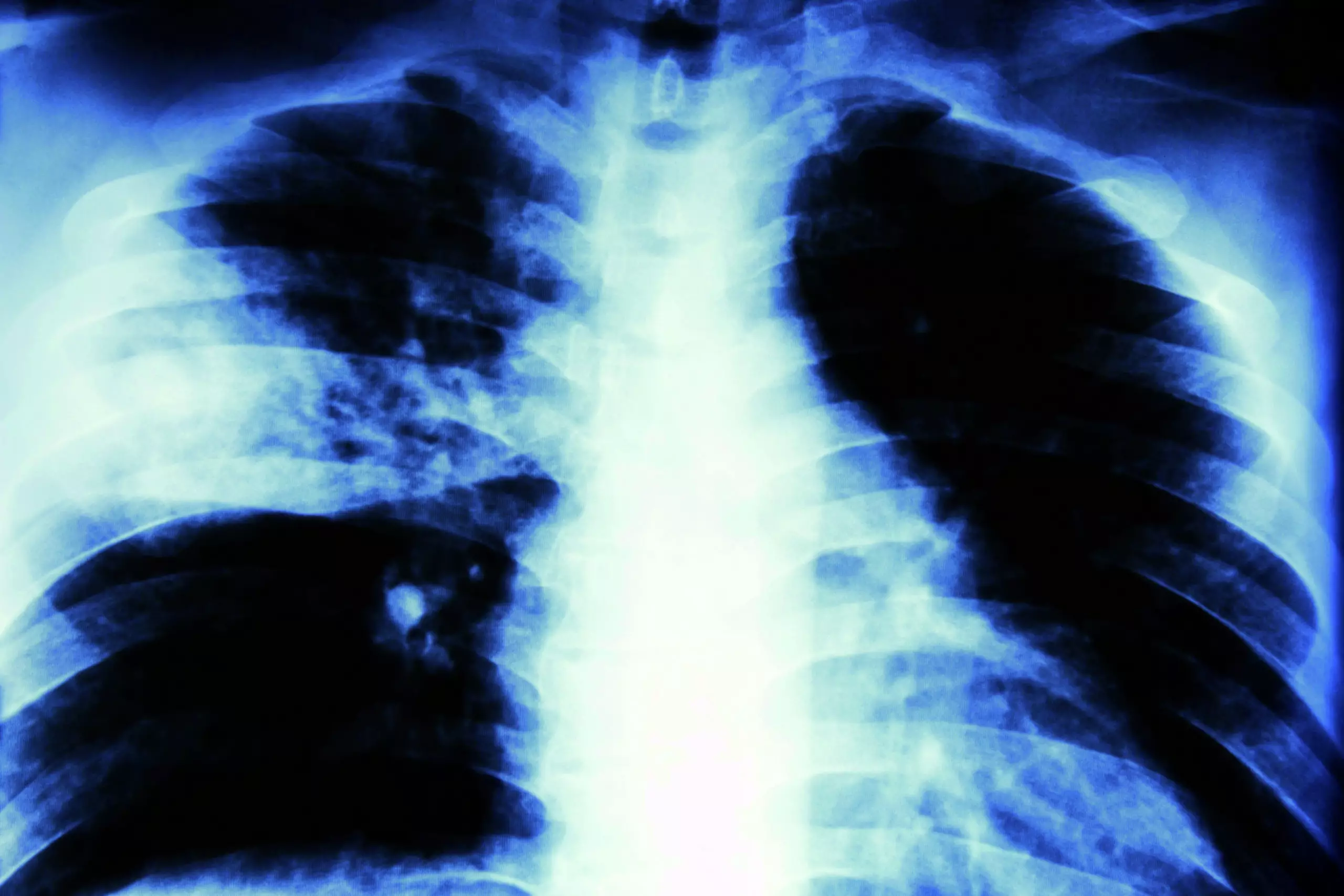 Lung Bacteria Imaging Tool Could Help Tackle Antibiotic Resistance   Pneumonia Lungs Ss 17 Scaled 