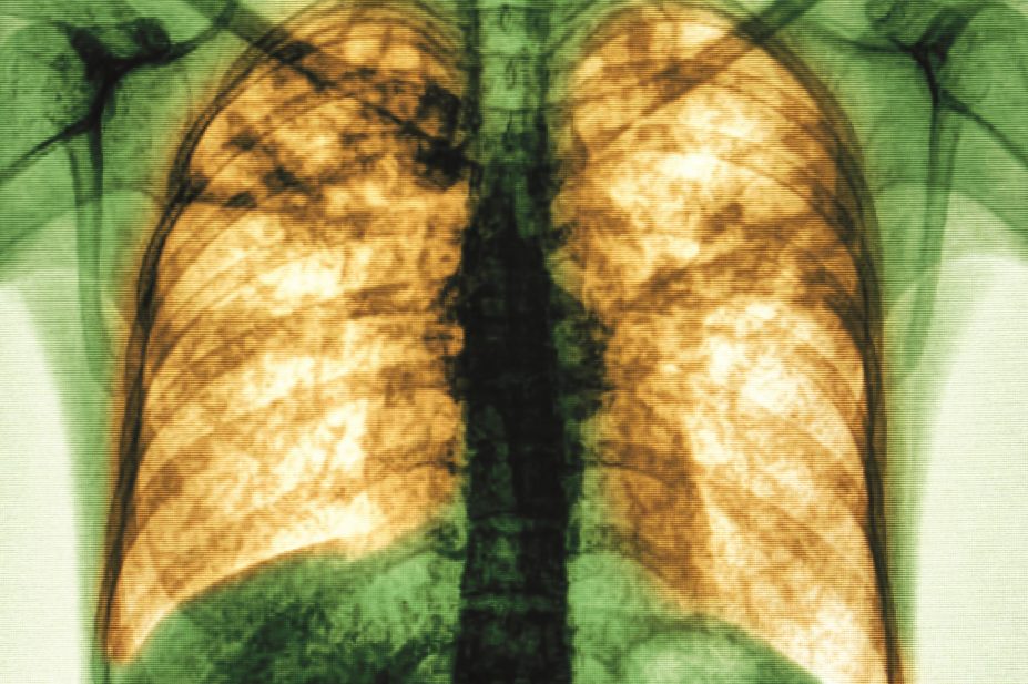 Corticosteroids significantly reduce mortality, the need for mechanical ventilation and hospital stay in adults with community acquired pneumonia, say researchers. In the image, x-ray of a patient suffering from pneumonia