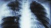 X-ray of a patient's lungs with pneumonia
