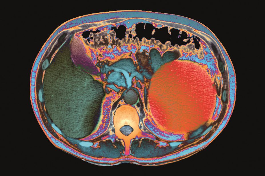 Proton pump inhibitors (PPIs) are associated with a 20% – 50% increase in the risk of developing chronic kidney disease (CKD), according to new research. In the image, CT scan of polycystic kidneys