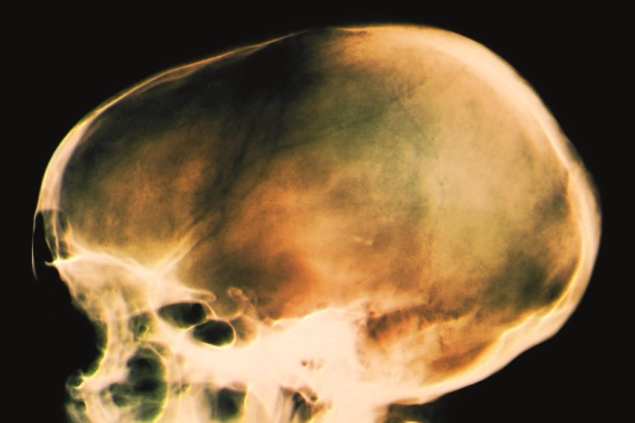 The FDA has told Zafgen that its investigational new drug application for obesity, beloranib, has been put on hold after the death of a patient with Prader-Willi syndrome (PWS) during a clinical trial. In the image, x-ray of a patient's head with PWS