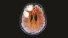 The US Food and Drug Administration has issued a new safety warning about cases of progressive multifocal leukoencephalopathy (PML) in multiple sclerosis patients taking fingolimod (Gilenya). In the image, an MRE scan of a patient with PML