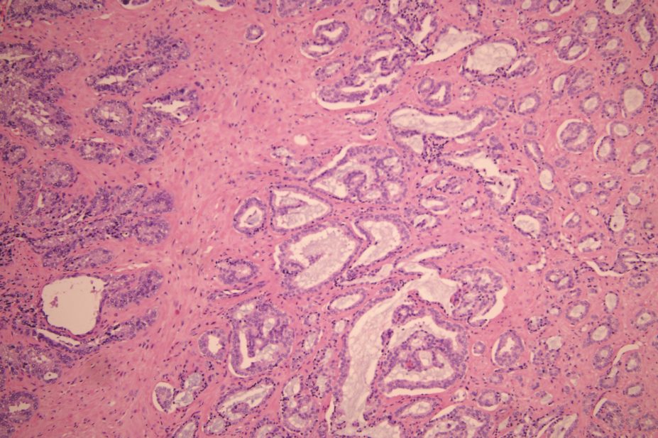 Olaparib, a drug approved for the treatment of women with ovarian cancer who have inherited BRCA mutations, also benefits men with prostate cancer. In the image, prostate cancer cells