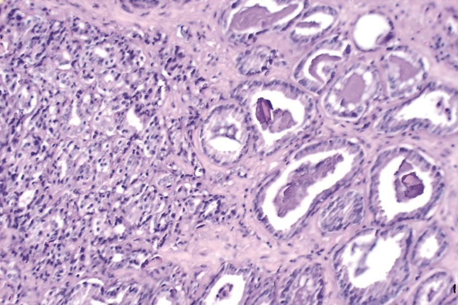 Androgen-deprivation therapy (ADT) used as treatment for prostate cancer (pictured) can increase the risk of heart disease