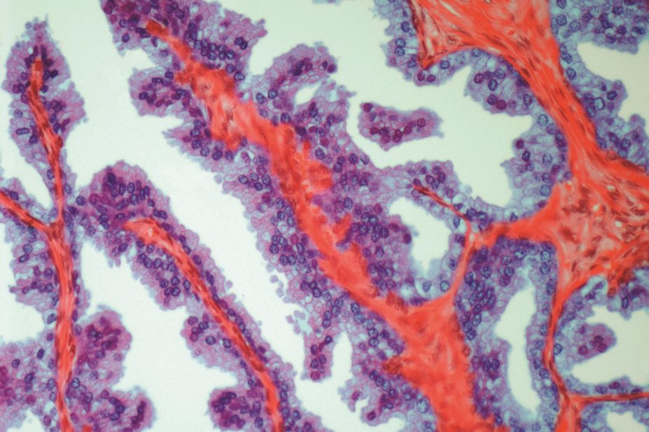 A third of men with advanced prostate cancer (light micrograph, pictured) could benefit from a drug currently licensed for women with ovarian cancer