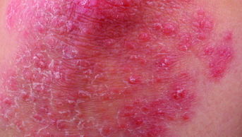 Close up of psoriasis in the arm