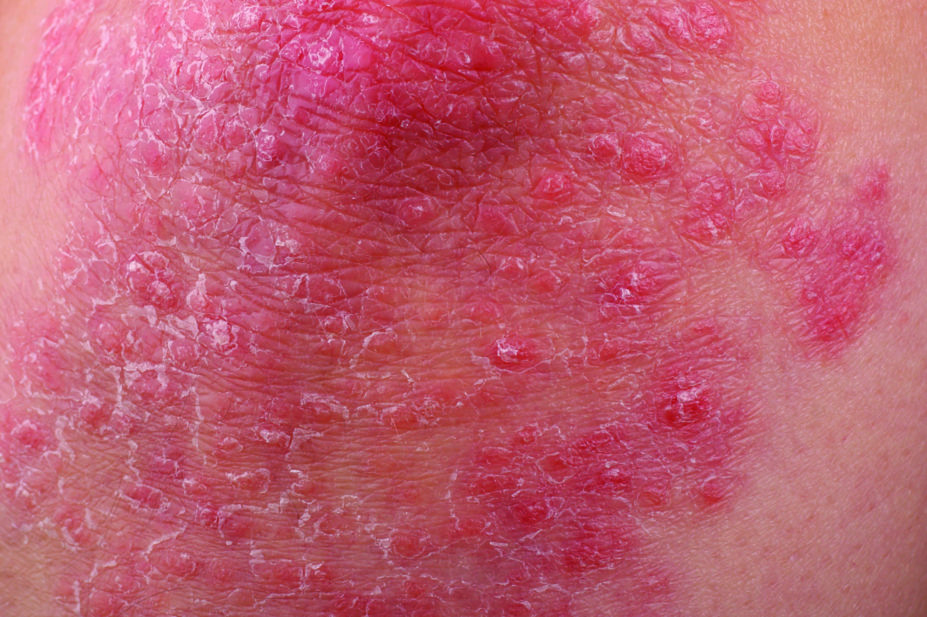 Close up of psoriasis in the arm