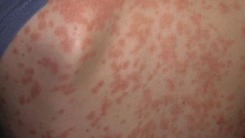 Back of a female suffering from severe psoriasis