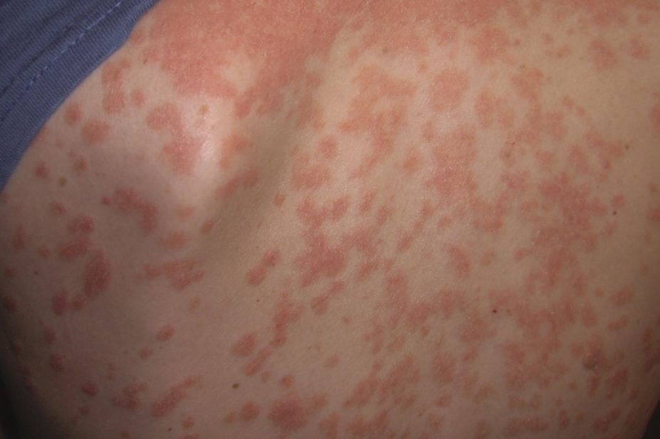 Back of a female suffering from severe psoriasis
