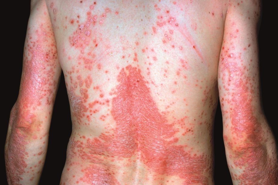Biologics and small-molecule drugs being developed to treat psoriasis are showing encouraging results, but their high cost could limit their use.