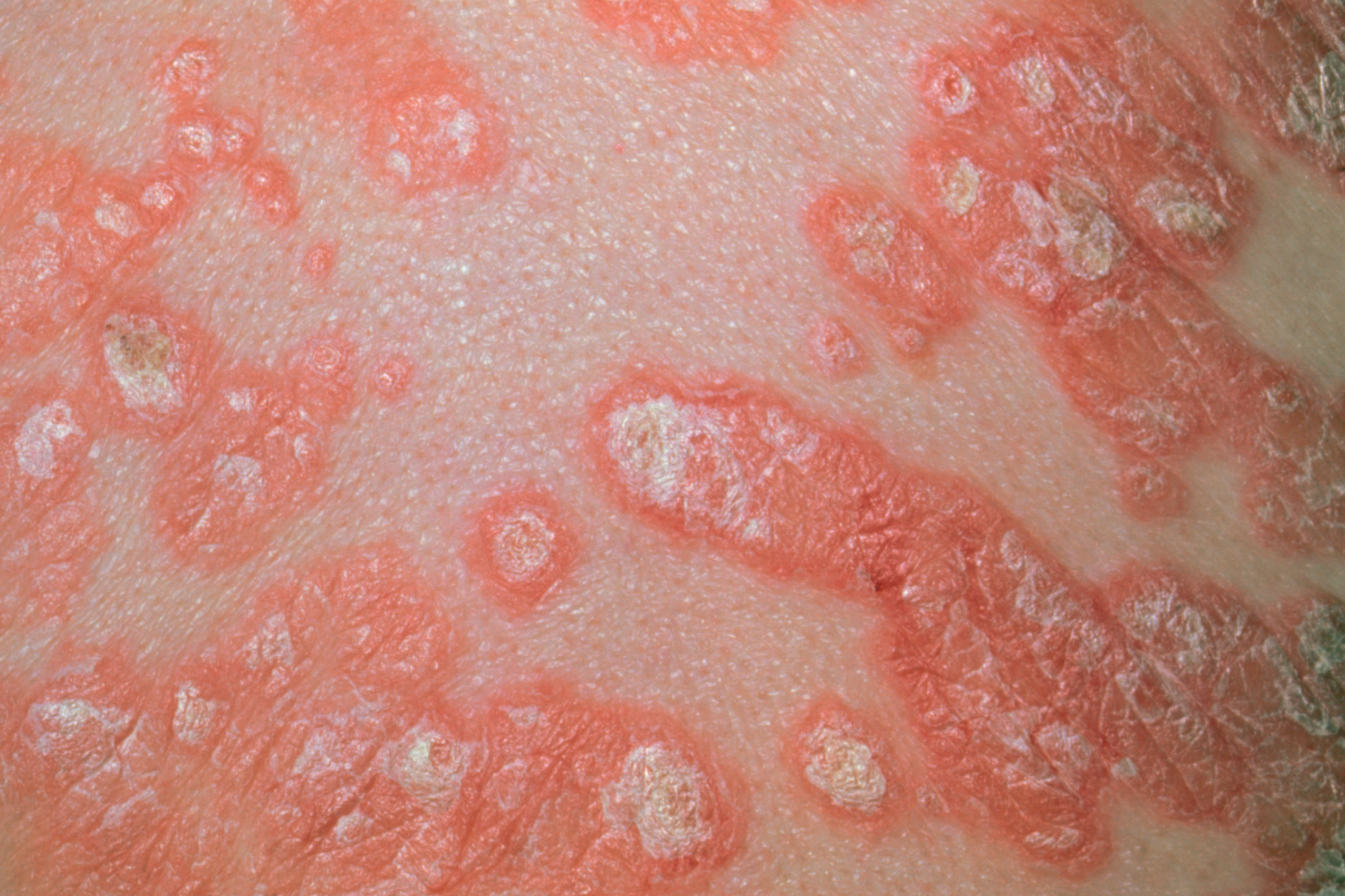 management of psoriasis in primary care)